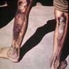 Radiation burns